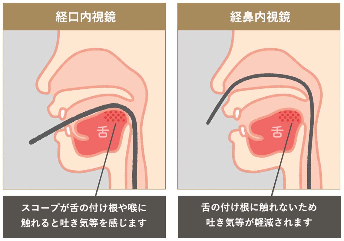 経鼻内視鏡、経口内視鏡イメージ画像